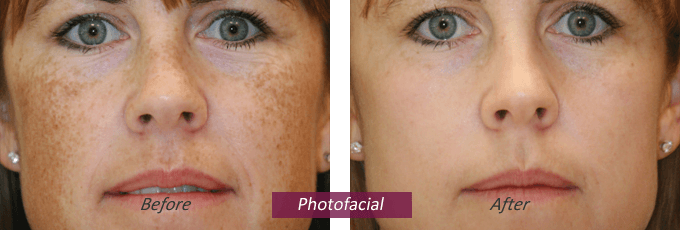 Laser Skin Resurfacing Before and After Pictures Denver, CO