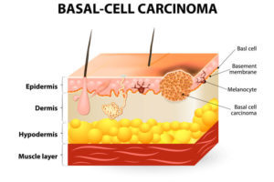 Skin Cancer Surgery/Treatment in Denver, CO
